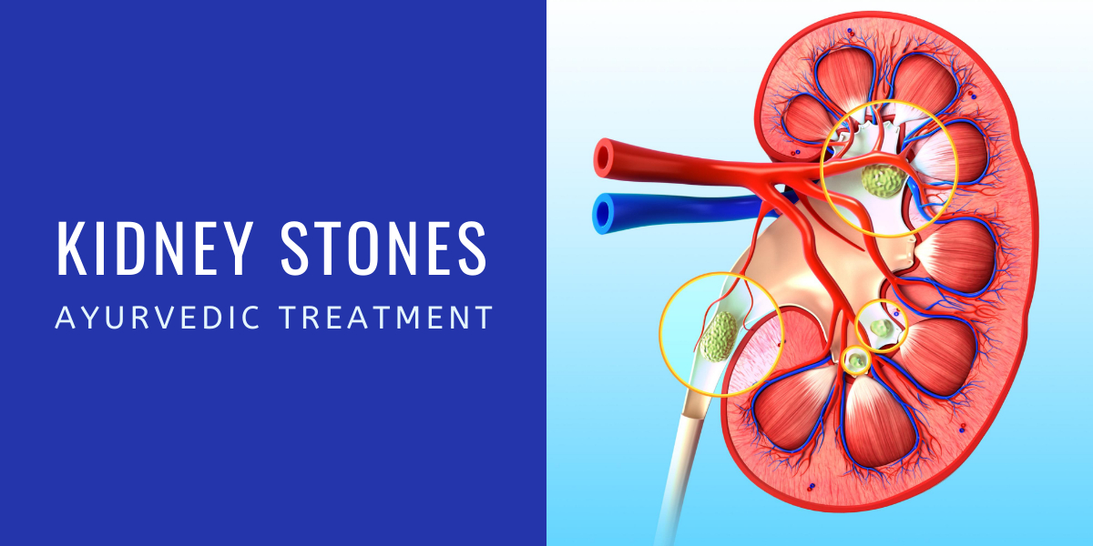 Ayurvedic Medicine for Kidney Stone Total Ayurveda Ayurvedic Clinic