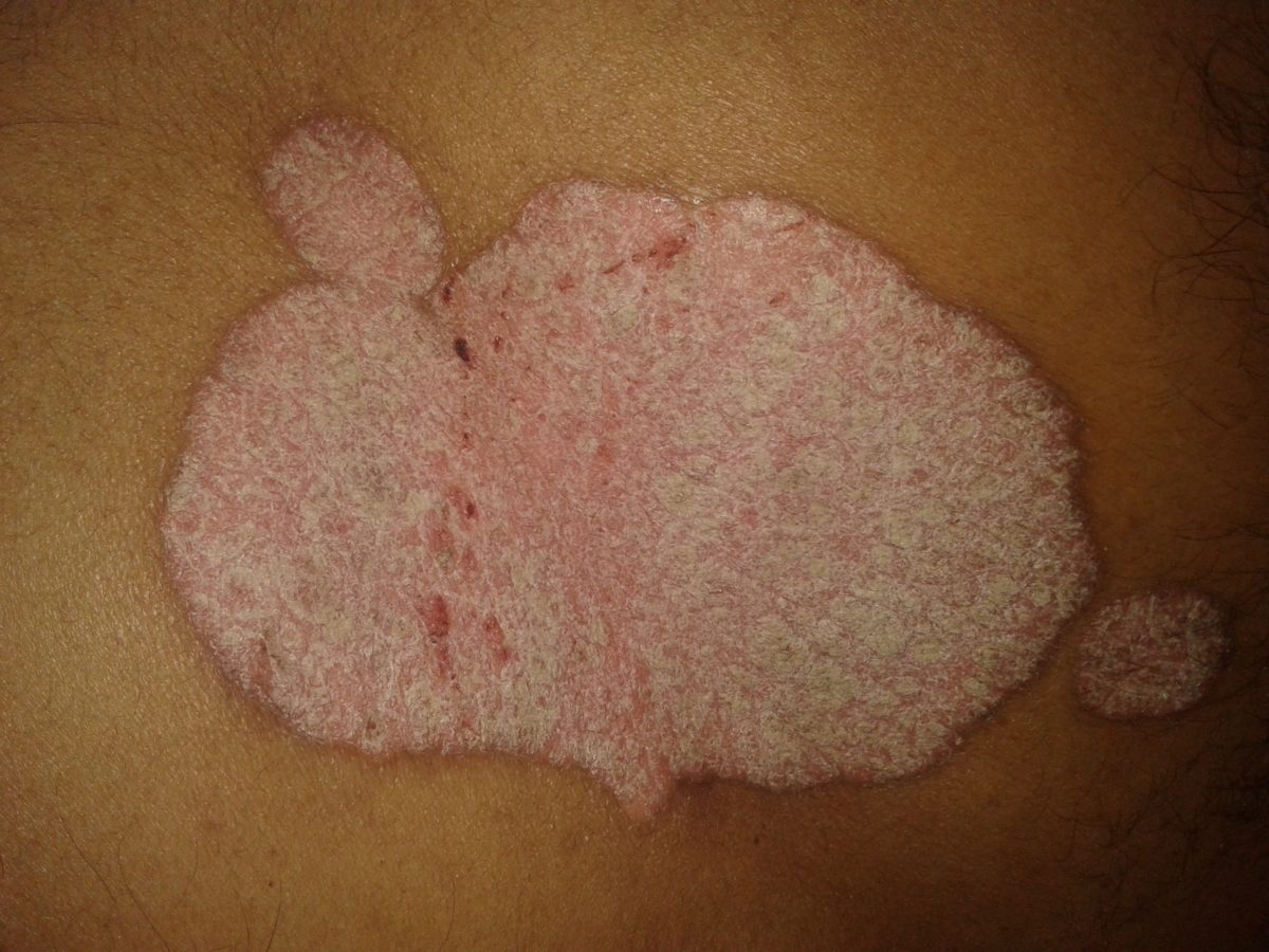 Plaque Psoriasis