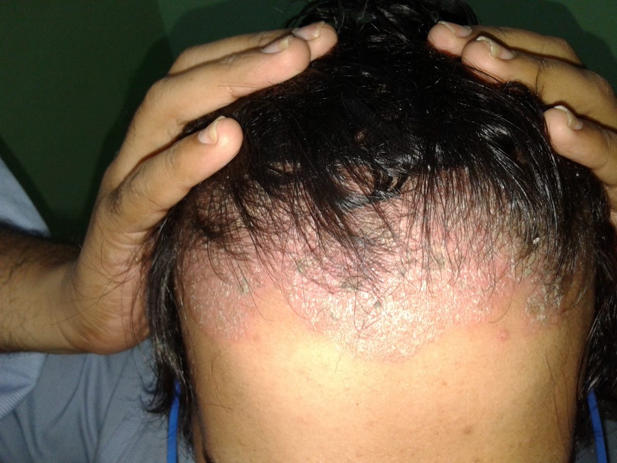 Scalp Psoriasis