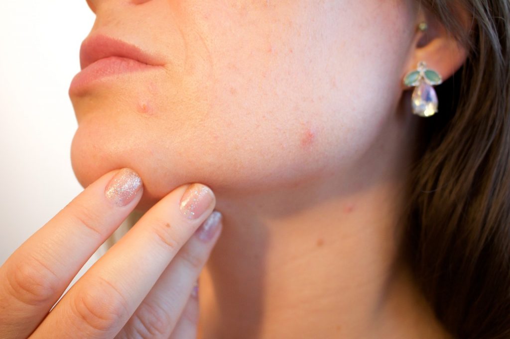 acne pimple