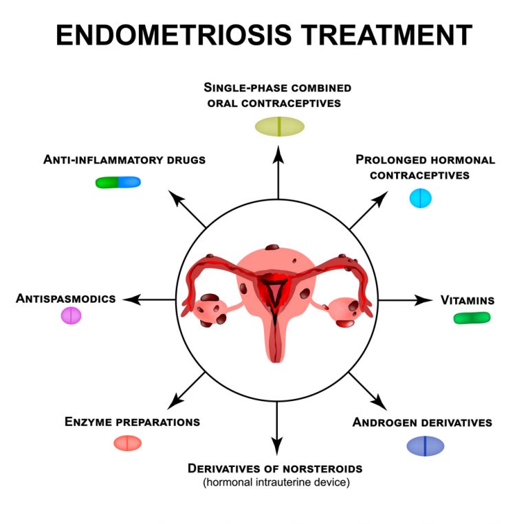 Endometriosis and its Treatment