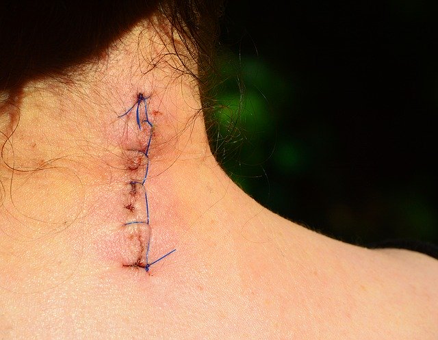 Neck pain surgery