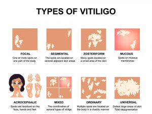 Types of vitiligo