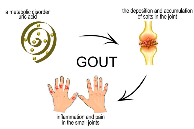 Ayurvedic Gout Treatment