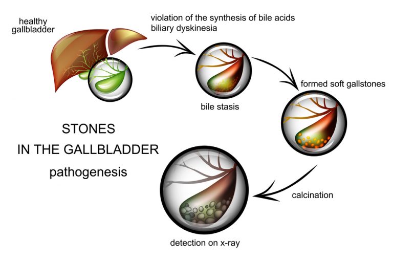 Gallbladder Stone Treatment in Ayurveda Total Ayurveda