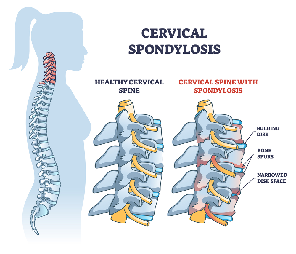 Cervical Spondylosis Treatment In Ayurveda
