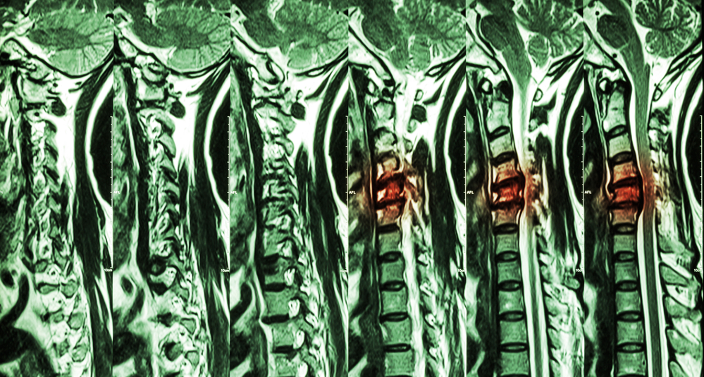 Cervical Spondylosis With Disc Herniation ( MRI Of Cervical Spine