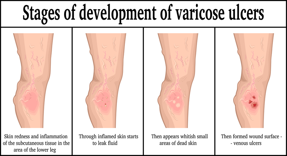 Stages of development of varicose ulcers