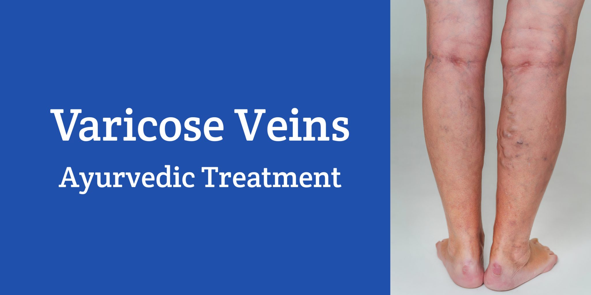 Varicose Veins Ayurvedic Treatment