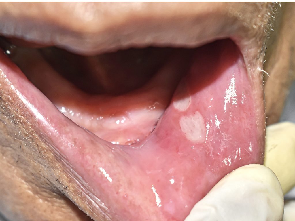 Ayurvedic treatments for mouth ulcers