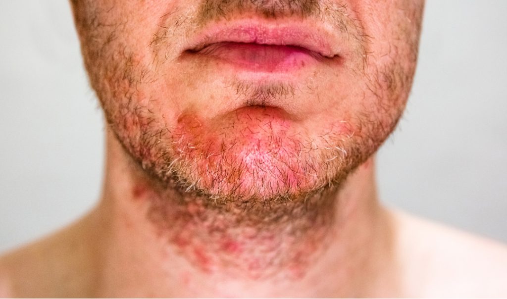 Seborrhoeic Dermatitis