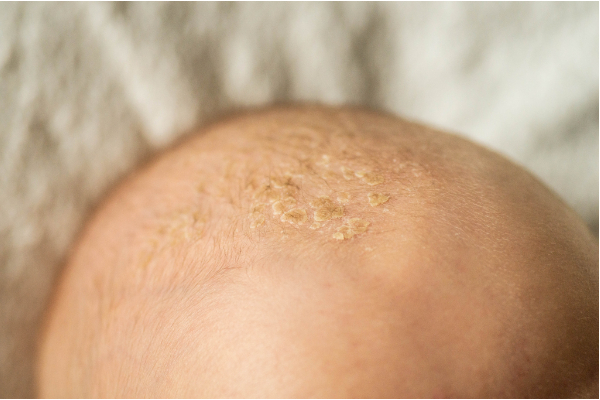 seborrhoeic dermatitis scalp