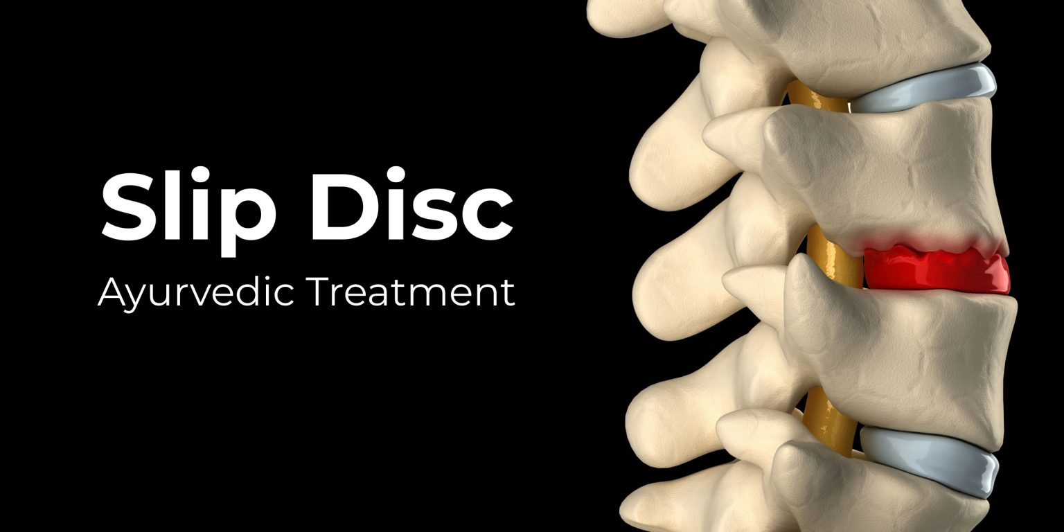 Slip Disc Treatment